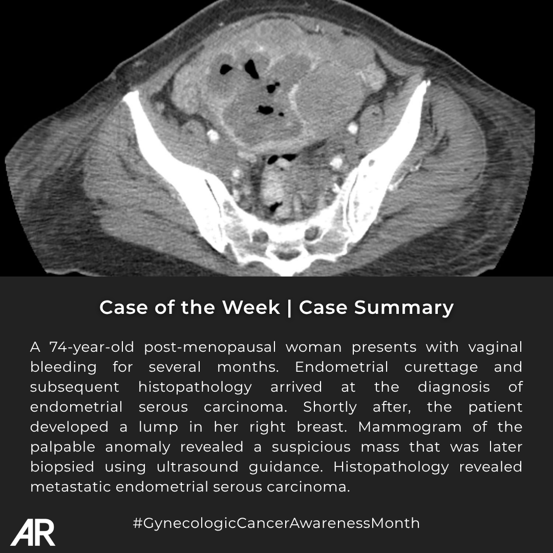 Applied_Rad's tweet photo. 🩻 Case Study of the Week!

A 74-year-old postmenopausal woman presents with vaginal bleeding for several months. 

🔗 See all the case details, more images, and the diagnosis: https://t.co/xq8lJEUMHj 

#Radiology #RadEd #MedEd #RadiologyEducation #COW #CaseOfTheWeek #GynecologicCancerAwarenessMonth #GynecologicCancer