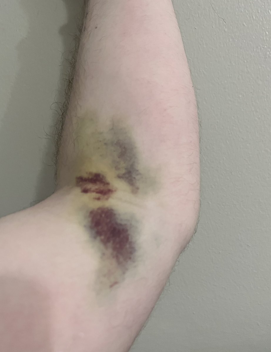 dingle_biter's tweet photo. I have to go to the doctor in an hour bruh I wouldn’t believe me either that yes everything is okay at home and this is actually from an equipment malfunction during the blood draw that I got specifically for this appointment https://t.co/PVrEEvNnlc