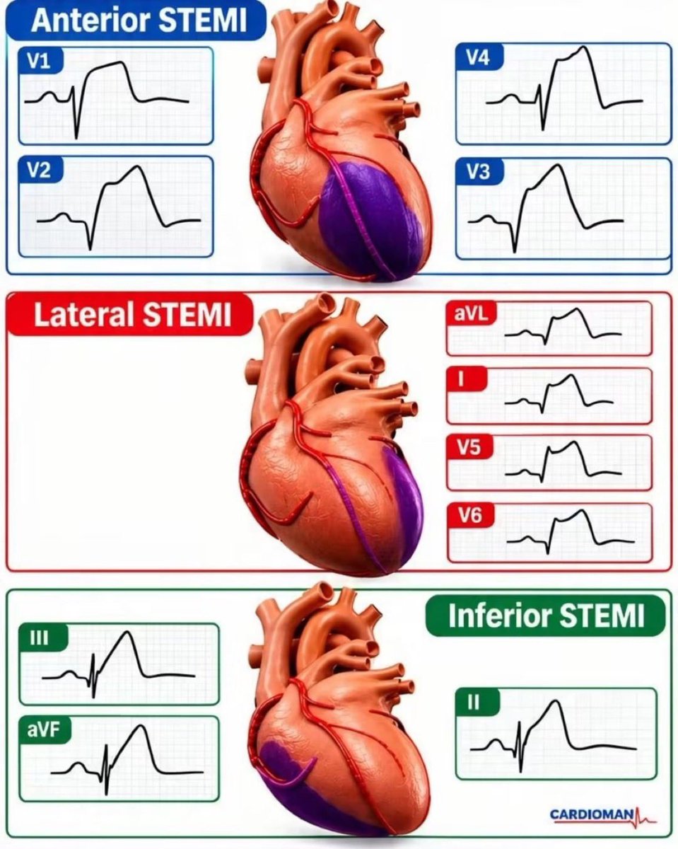 DR_KH10HA's tweet photo. صورة مهمة تشرح 
STEMI ( ST-Elevation Myocardial Infarction )

وتوضح مكان احتشاء عضلة القلب حسب ال 
( ECG leads ) https://t.co/coJlTWZOr1