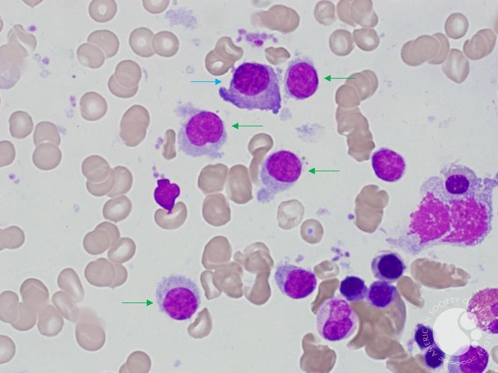 smbenlazar's tweet photo. Hairy Cell Leukaemia and Multiple Myeloma | ASH Image Bank | American Society of Hematology https://t.co/l8segKSig3 #ASHImageBank https://t.co/OnjQQpwz2M