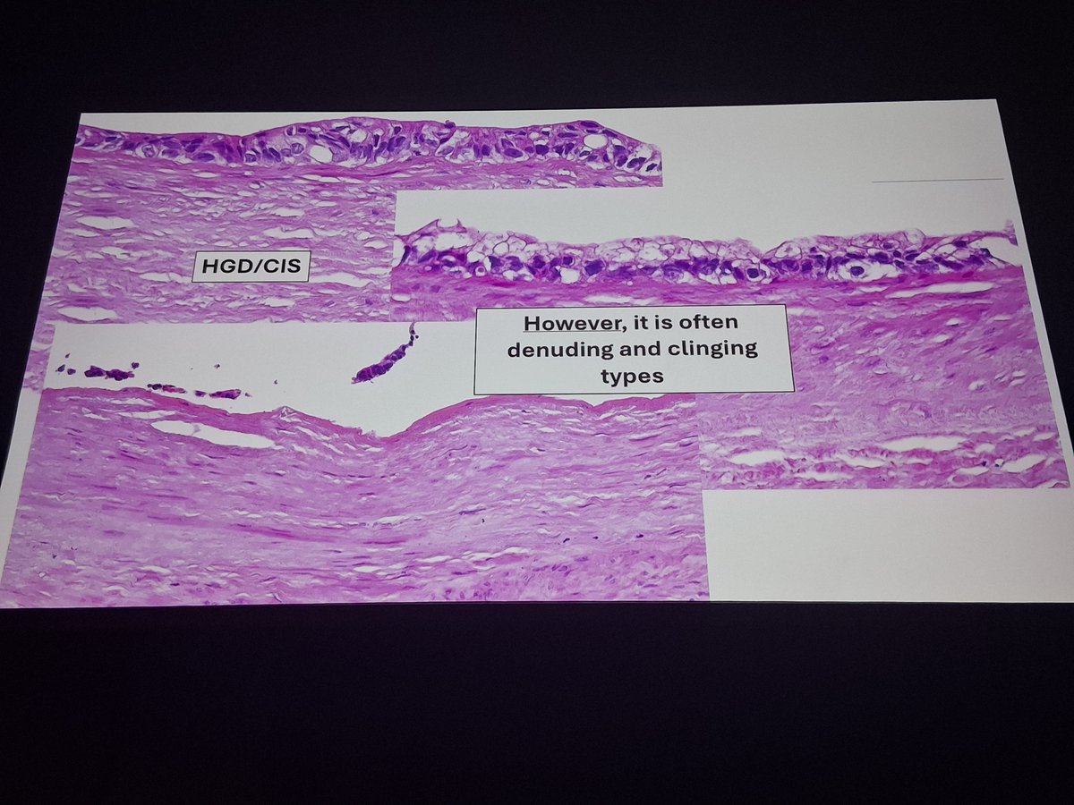 Chris_PouliosMD's tweet photo. The horror....
Clinging tumour cell groups, spots of high grade atypia in routine gallbladder resections....
To say 'easy to miss' is an understatememt.  
Videomicroscopy by Prof. Adsay at #ESPCongress https://t.co/7YBS5aolR5