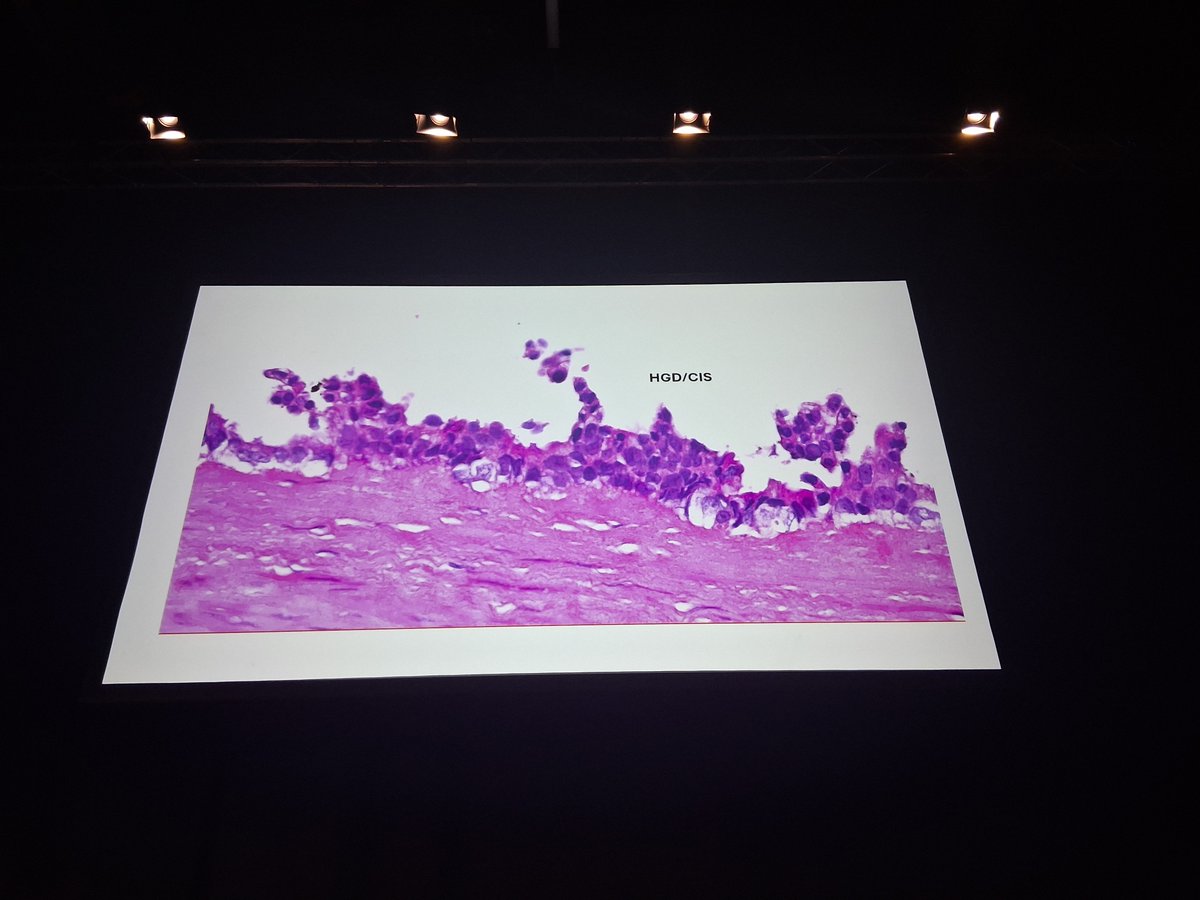 Chris_PouliosMD's tweet photo. The horror....
Clinging tumour cell groups, spots of high grade atypia in routine gallbladder resections....
To say 'easy to miss' is an understatememt.  
Videomicroscopy by Prof. Adsay at #ESPCongress https://t.co/7YBS5aolR5
