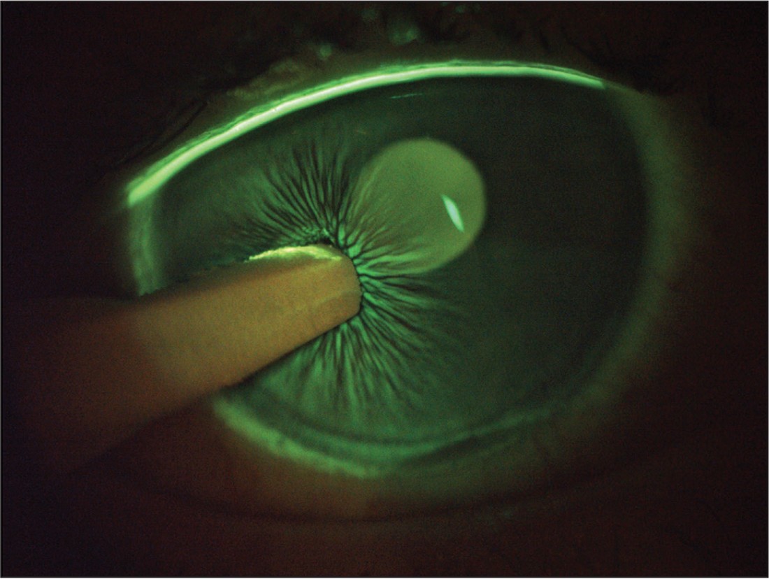 SLACKOphthal's tweet photo. Close-up photograph of an eye under fluorescein light during an epithelial stress test. 

Read more: https://t.co/ELNN1ZVbVC

#ophthalmology #refractivesurgery https://t.co/kwCIYiWoWd