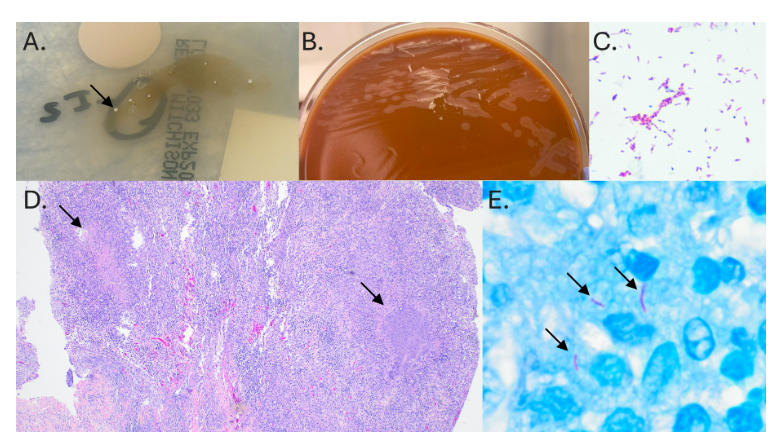 ASMicrobiology's tweet photo. #JClinMicro photo quiz! A woman with a history of cardiac sarcoidosis presented with right dorsal wrist pain and swelling. What organism was causing the patient’s granulomatous synovitis? https://t.co/GJxEVJVwJp https://t.co/jyU38THoHq