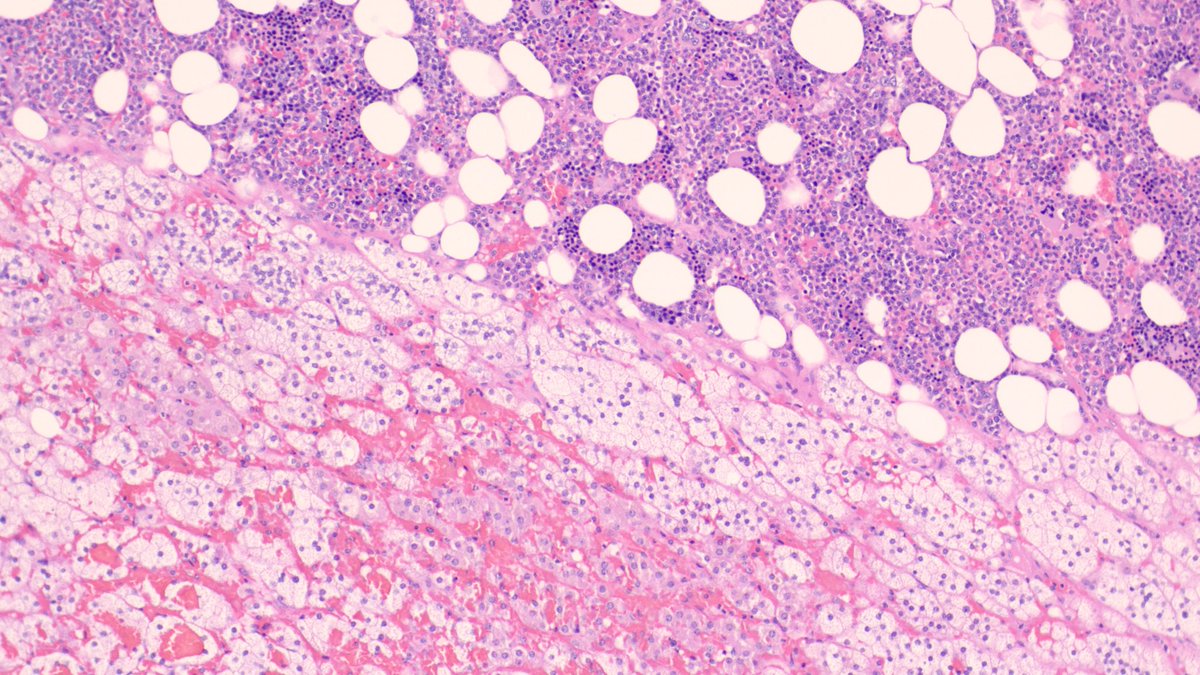 AMubeen_Path's tweet photo. This one is for pathology residents. One picture only! 
#GUpath #endopath https://t.co/XXvoWLk1mV