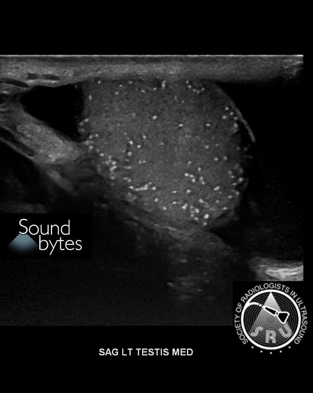 sruradiology's tweet photo. Dx: Testicular Microlithiasis
Findings: Numerous punctate echogenic foci throughout the left testicle.
Case courtesy of Michael Weintraub, MD, MassGeneral Brigham
#RadResidents #ultrasound #RadInTraining https://t.co/CwkVq7iyqz