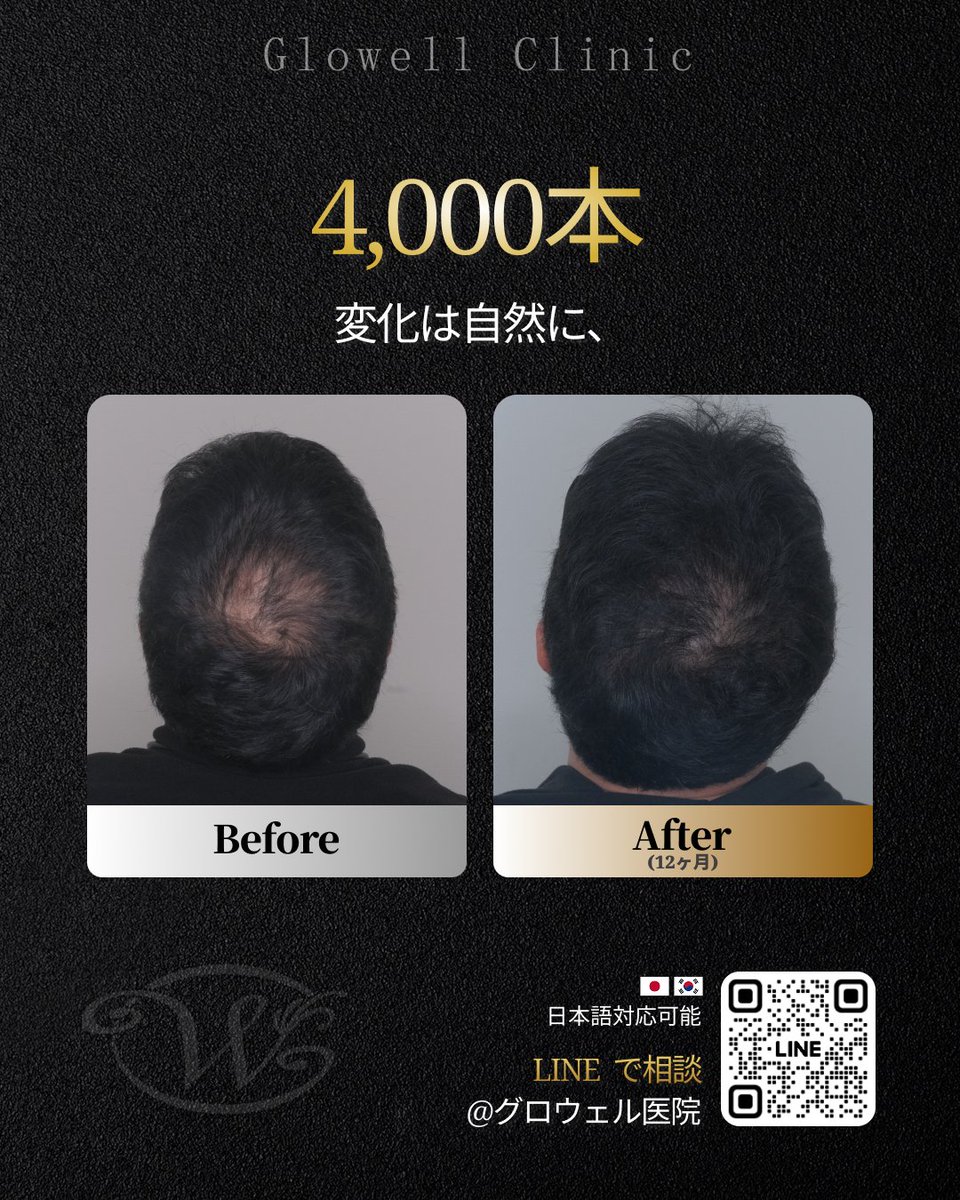 gwl26319900's tweet photo. 植えたことが目立つのは避けたい…
そんな方に大切なのは、自然になじむ仕上がりです👀

4,000本を植毛し、
頭頂部をさりげなく整えた症例です✅

“埋めた感”より
“自然に見えること”を重視したい方へ🤗

📍韓国・汝矣島 グロウェル医院
🌐日本語対応可能
https://t.co/3MBaBq7Uy0

#韓国植毛 #頭頂部植毛 #自毛植毛