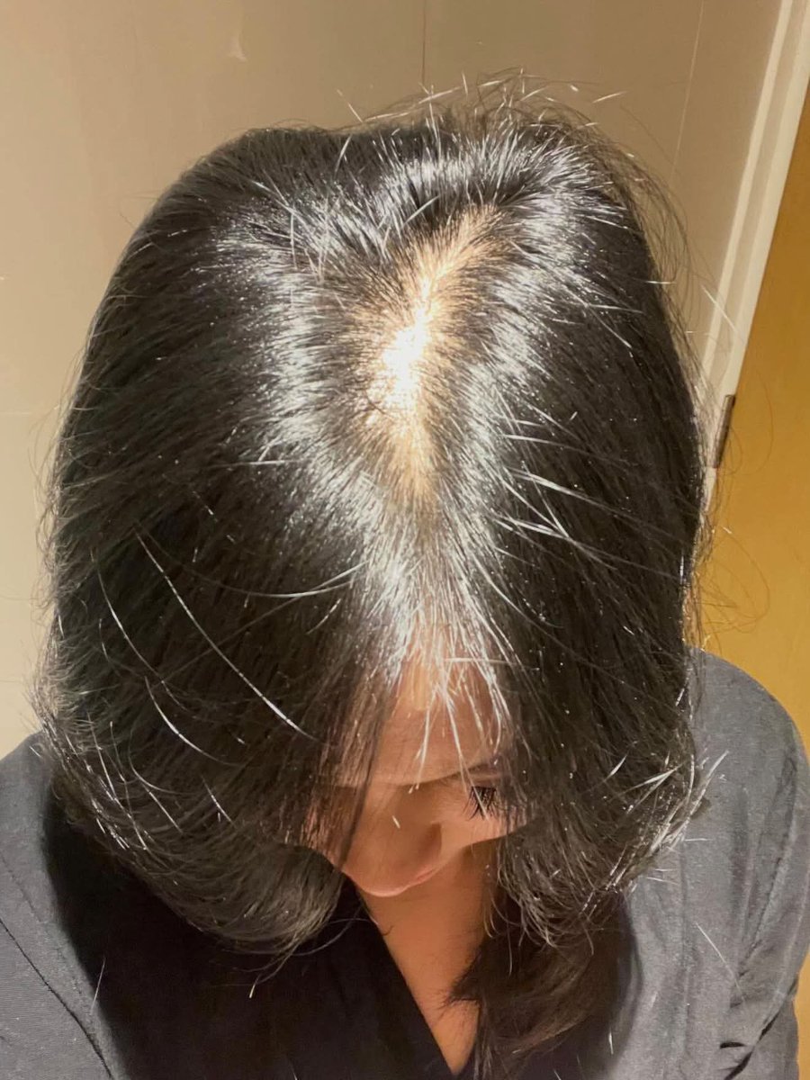 accresst's tweet photo. Dr Tirta sadar gak yaaa kalo belio udah banyak bikin cantik perempuan ??🥹🥹

Before: rambut setipis tissue krn rontok
After: banyak buanget numbuh babyhair https://t.co/qCZ3bR5Og7