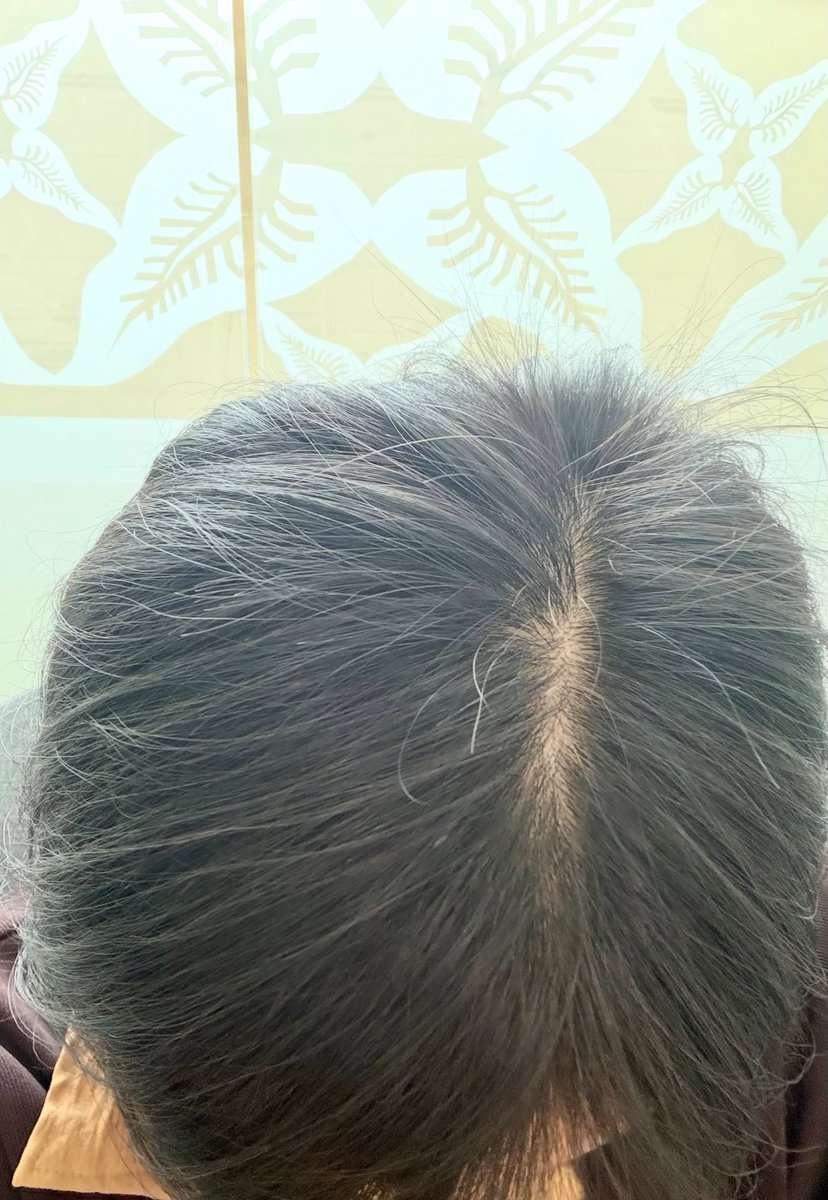 accresst's tweet photo. Dr Tirta sadar gak yaaa kalo belio udah banyak bikin cantik perempuan ??🥹🥹

Before: rambut setipis tissue krn rontok
After: banyak buanget numbuh babyhair https://t.co/qCZ3bR5Og7