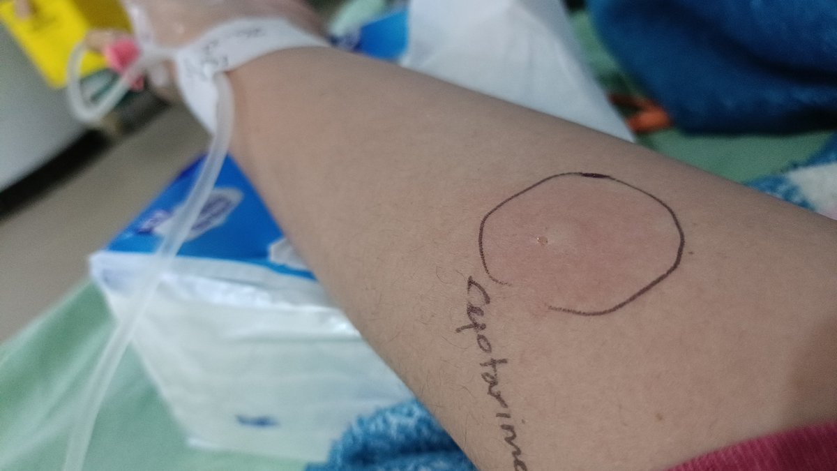adnaluw's tweet photo. @afrkml Aaa jadi inget ini. Perih panas, gatel. Sampe kayak melepuh itu bekas suntikannya 😭 https://t.co/AO94lmoC3G
