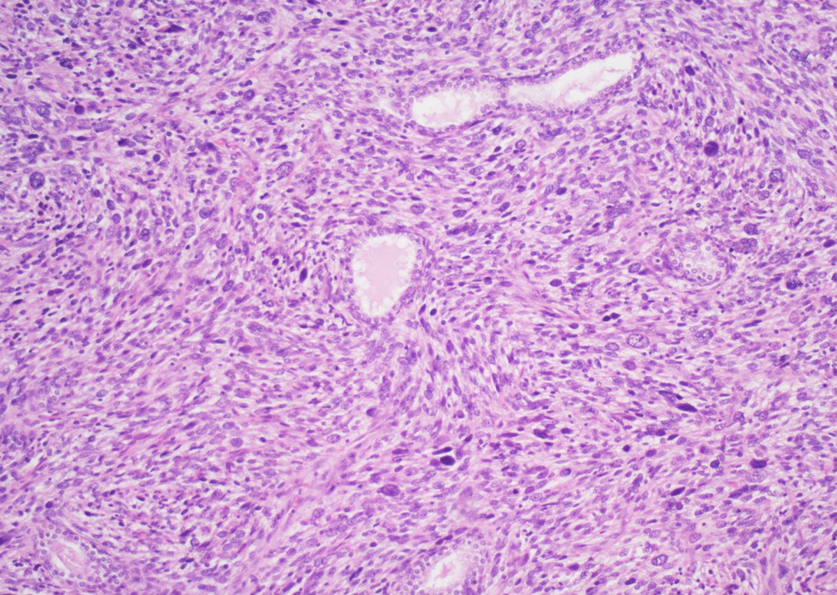 GuannanTiffany's tweet photo. 🧩 Prostate riddle

Continue exploring our favorite series of rare prostate tumors.

The case below offers a hint.

#DxMindMap #ProstatePath #GUPath #PathTwitter @JHUpath @MGBpathology https://t.co/zMQnGnlY32