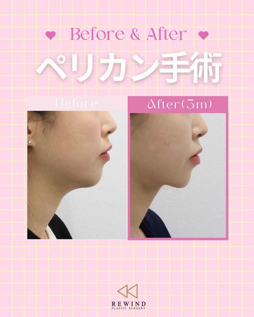 re_wind_jp's tweet photo. ✔️ペリカン手術
Before &amp; After

🪞✨リワインド整形外科✨🪞
お悩みに合わせて、患者様一人ひとりに合ったデザインをご提案いたします💕

#ペリカン手術 #糸リフト #リフトアップ #リワインド整形外科 #渡韓整形 https://t.co/mAFLbKGLuR