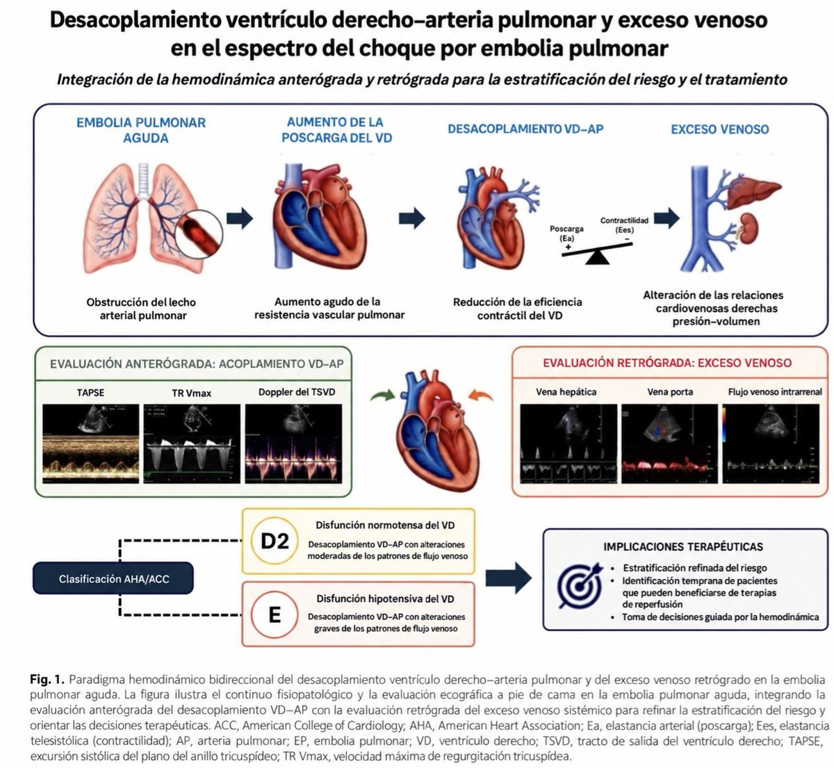 LeslieMegom's tweet photo. 🔰Desacoplamiento ventrículo🫀 derecho–arteria pulmonar y exceso venoso en la embolia pulmonar normotensa🫁
🧑🏻‍⚕️🇲🇽 Gasca-Aldama JC,López Rodríguez H.Vidals M. et al. Right ventricular–pulmonary arterial uncoupling and venous excess in normotensive pulmonary embolism shock. Critical Care. 2026;30:456. doi:10.1186/s13054-026-06302-4
🫀La presión arterial conservada no excluye choque obstructivo en la embolia pulmonar aguda. Un paciente puede mantener una PAS ≥90 mmHg mediante vasoconstricción compensadora y, simultáneamente, presentar:
⏩️Bajo volumen sistólico y gasto cardiaco.🫀
⏩️Hipoperfusión tisular.🫀
⏩️Desacoplamiento ventrículo derecho–arteria pulmonar.🫁↔️🫀
⏩️Incremento de la presión auricular derecha. 
⏩️Congestión venosa sistémica y disfunción orgánica.
📖El trabajo de Gasca-Aldama y colaboradores propone evaluar la circulación desde dos direcciones complementarias:
1️⃣Evaluación anterógrada.
●🫀Capacidad del VD para eyectar contra la circulación pulmonar Consecuencias del fallo del VD sobre el territorio venoso.
●🫀TAPSE/PASP · TAPSE/velocidad de regurgitación tricuspídea (TRV) tiempo de aceleración pulmonar PAAT,  muesca mesosistólica.
●🫀Identifica desacoplamiento VD–AP.
 2️⃣Evaluación retrógrada.
●🫀Consecuencias del fallo del VD sobre el territorio venoso.
●🫀VExUS: VCI y Doppler hepático, portal y renal.
●🫀Identifica desacoplamiento VD–AP Identifica transmisión retrógrada de presión y exceso venoso
☝🏻🤓La combinación podría reconocer precozmente al paciente con choque normotenso categoría D2, antes de la hipotensión manifiesta y el colapso cardiovascular. El concepto concuerda con la nueva clasificación A–E de la guía estadounidense de embolia pulmonar de 2026.
▪︎Guía AHA/ACC 2026
🔴 1️⃣. Fisiopatología del desacoplamiento VD–arteria pulmonar.🫁🫀
✴️En condiciones normales, el VD adapta su contractilidad a la poscarga pulmonar:
■Acoplamiento VD-AP=Ees /Ea
🔴Ees: Elastancia telesistólica, expresión de contractilidad ventricular.
🔴Ea: Elastancia arterial efectiva, representación integrada de la poscarga pulmonar.🫁
☝🏻🤓La obstrucción vascular pulmonar aguda aumenta bruscamente la resistencia vascular pulmonar y la Ea. A diferencia del VI, el VD de pared delgada tolera mal un incremento súbito de poscarga.
🧑🏻‍⚕️La secuencia fisiopatológica es:
➡️1. Aumenta la poscarga pulmonar.
➡️2. El VD incrementa inicialmente su contractilidad para preservar el acoplamiento.
➡️3. Cuando la reserva contráctil se agota, disminuye el volumen sistólico.
➡️4. Aumentan el volumen telesistólico y la dilatación del VD.
➡️5. Se eleva la presión telediastólica del VD y la presión auricular derecha.
➡️6. Aparece desplazamiento septal, menor llenado del VI y caída adicional del gasto cardiaco.
➡️7. La presión arterial puede permanecer transitoriamente normal por vasoconstricción, pese a existir hipoperfusión.
⚠️IMPORTANTE ‼️: La hipotensión es un signo tardío, no el comienzo fisiológico del choque.
🔴2️⃣TAPSE/PASP: Estimación anterógrada del acoplamiento:
TAPSE/PASP=excursión sistólica del anillo tricuspídeo/presión sistólica de la arteria pulmonar.
●TAPSE: Respuesta contráctil longitudinal del VD.
●PASP: Carga contra la cual debe eyectar el VD.
☝🏻🤓Un TAPSE aislado relativamente conservado puede ser insuficiente si la poscarga es muy elevada.                 🔴De igual manera, una PASP elevada puede representar una respuesta todavía adaptativa si el VD conserva contractilidad. La relación entre ambas variables resulta fisiológicamente más informativa.
☝🏻🤓Umbral clínicamente relevante
📖El artículo destaca:
●TAPSE/PASP}<0.34 mm/mmHg.
🫀Este valor se ha relacionado con:
●Desacoplamiento VD–AP;
●índice cardiaco <2.2 L/min/m²;
●Sensibilidad de 97% y especificidad de 91% para bajo índice cardiaco en la cohorte citada.
●Mayor probabilidad de una respuesta hemodinámica importante después de trombectomía mecánica, definida como aumento ≥25% del índice cardiaco.👇🏽
@pepeska015