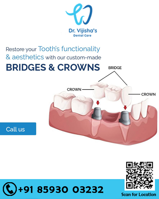 VijishasDental's tweet photo. Restore your Tooth's functionality & aesthetics with our custom-made BRIDGES & CROWNS
Schedule a consultation 🦷💯
𝐆𝐢𝐯𝐞 𝐮𝐬 𝐚 𝐜𝐚𝐥𝐥 𝐨𝐧 ☎️👇👇:
📍 #Guruvayoor : +91 85930 03232, 85890 03232
#Bridges #Crowns #DrVijisha💜 #DentalClinicGuruvayur #Toothache https://t.co/PVLCbKtjdU