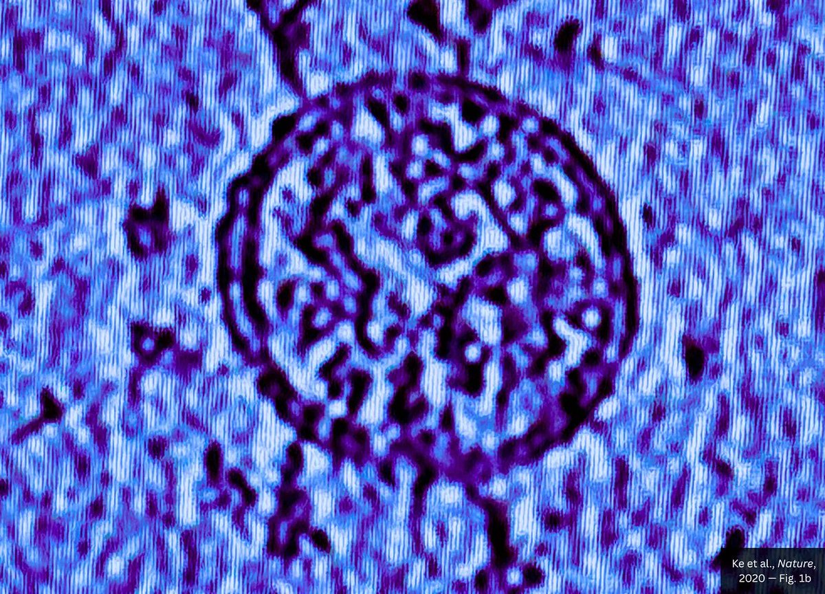 Alzhacker's tweet photo. スパイク単独29%、添加で95%。副反応の真犯人は「スパイク」ではない

SARS-CoV-2のスパイクタンパク質は、炎症や血管障害を引き起こす元凶として長らく槍玉に挙げてきた。だが、人間を対象としたランダム化比較試験のデータは、この前提を根底から揺さぶる事実を突きつけている。

2021年、医学誌『The Lancet Infectious Diseases』に掲載されたサノフィと米国政府機関による試験結果を見てみよう。免疫賦活剤（アジュバント）を含まない組換えスパイクタンパク質だけを投与されたグループの反応率は、わずか29%だった。

これは偽薬（生理食塩水）を投与されたグループの21%と、驚くほど近い数字である。研究者らも、両群の全身反応は「低く類似している」と記述しており、統計的な有意差は見られなかった。

ところが、ここにアジュバントという「混ぜ物」が加わると、事態は劇変する。反応率は81%から95%へと跳ね上がったのだ。

免疫応答の指標である中和抗体価も同様の二極化を示した。2回目の投与後、スパイク単独群と偽薬群はともに5.00という数値で横並びだった。一方、アジュバント添加群では最大75.1まで上昇している。

スパイク単独は、生理食塩水と区別がつかないほど静かだった。

「スパイクそのものが毒性を持つ」という通説に対し、ヒトのデータは「添加物がなければ、スパイク単独は生理食塩水とほぼ同様の反応しか引き起こさない」と告げている。しかし、この重要な「単独群」は、その後の大規模な有効性試験から姿を消した。サノフィはアジュバント入り製剤を採用し、成分ごとの寄与度を切り分ける比較対照を放棄したのだ。

この「成分の切り分け放棄」は、mRNAワクチン開発においても繰り返された。モデルナ等の主要な治験では、完成されたmRNAと脂質ナノ粒子（LNP）の混合物が偽薬と比較されただけで、「中身の入っていない空のLNP」を投与するグループは設定されなかった。

この欠落が何を意味するか、2026年の『Nano Today』誌が衝撃的な事実を明らかにしている。研究者がmRNAを含まない「空のLNP」だけをがんのマウスに投与したところ、転移性腫瘍の負荷が対照群の10倍以上に増加したのだ。

さらに、注射部位の筋肉損傷、炎症細胞の浸潤、細胞壊死も確認された。遺伝子情報の有無にかかわらず、LNPという「入れ物」自体が組織を破壊し、がんの転移を促進したのである。

私たちが問うべきは、もはやスパイクの毒性だけではない。副反応の95%を生み出したのが「混ぜ物」だったとしたら、そして「プラセボ」自体に生物学的活性があったとしたら、私たちは一体何を体内に迎え入れたのか。その再検証が今、求められている。

—
Jon Fleetwood（ジャーナリスト、独立系調査報道記者）
記事 COVID ‘Spike Protein’ Alone Produces Few Acute Reactions in Humans—Reactions Surge to 95% Only After Other Vaccine Components Are Added: Journal ‘The Lancet’（COVID「スパイクタンパク質」単独ではヒトの急性反応は少ないが、他のワクチン成分が追加されると反応は95%まで急増する：医学誌『ランセット』）
https://t.co/uHsITPRj7L
