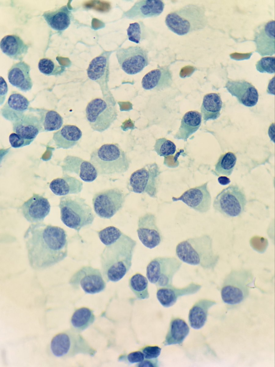 megha_lalcheta's tweet photo. Breast cytology, 62/F 

#Cytopath #Breastpath #PathX #FNAC #Pathology #Pathresidents #PathTwitter #Pathologists https://t.co/RV8ROCRlQC
