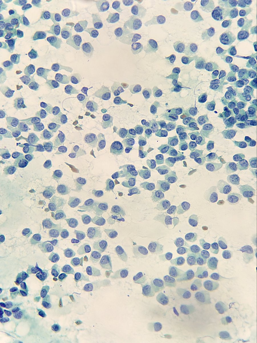 megha_lalcheta's tweet photo. Breast cytology, 62/F 

#Cytopath #Breastpath #PathX #FNAC #Pathology #Pathresidents #PathTwitter #Pathologists https://t.co/RV8ROCRlQC