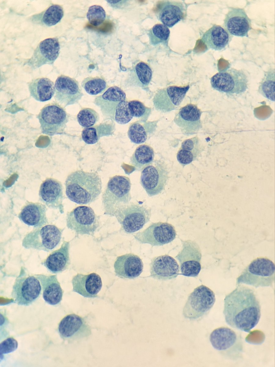 megha_lalcheta's tweet photo. Breast cytology, 62/F 

#Cytopath #Breastpath #PathX #FNAC #Pathology #Pathresidents #PathTwitter #Pathologists https://t.co/RV8ROCRlQC