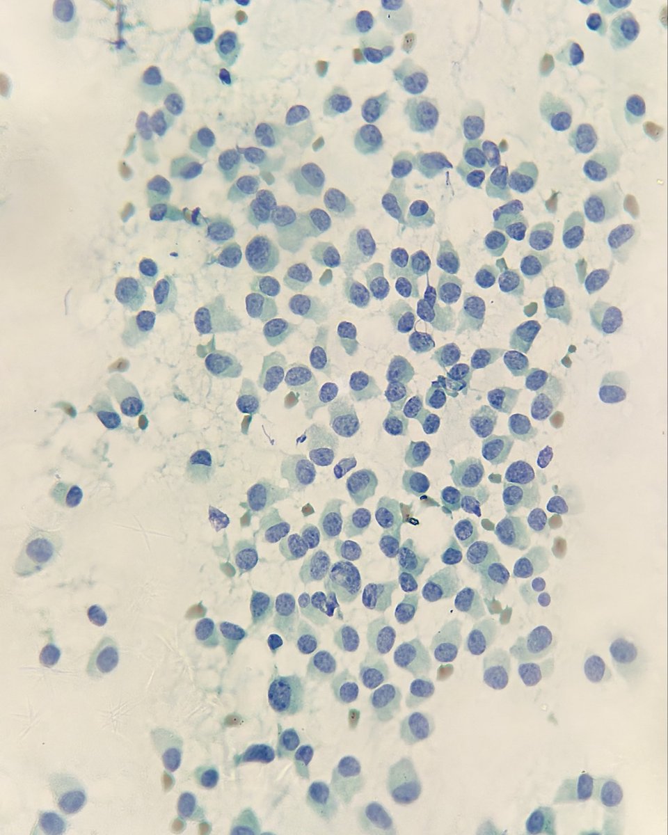 megha_lalcheta's tweet photo. Breast cytology, 62/F 

#Cytopath #Breastpath #PathX #FNAC #Pathology #Pathresidents #PathTwitter #Pathologists https://t.co/RV8ROCRlQC