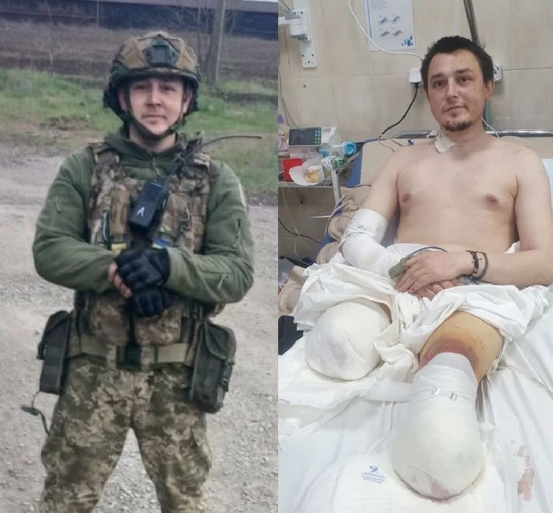 volodarskijo's tweet photo. Він лежав у траві без ніг, без зброї, без рації - і саме тоді почув голос побратимів: "Геродот! Де ти?"

Він думав поскручувати турнікети й стекти кров'ю, щоб не мучитися. А потім згадав, що обіцяв мамі повернутися.

Романа з позивним "Геродот", який вже півтора року в штурмовому підрозділі, - важко чимось здивувати. Його найдовший бойовий вихід тривав чотири місяці на "нулі".

Одного разу він вискочив у траншею як був - у шортах, футболці й кроксах на бо��у ногу. Схопив автомат і почав стріляти.

А коли бій закінчився, Геродот подивився на хлопців: усі в броні й касках, заряджені. А він у шортах і кроксах. Смішно. Хоча було смертельно небезпечно.

А через два з половиною тижні він пішов уночі по посилку й наступив на міну. Його підкинуло. Ліва стопа - на шмаття.

Він узяв ножиці й обрізав усе зайве по колу. Наклав два турнікети, закрутив так туго, що кістки хрустіли.

Через добу за ним прислали наземний робот. Разом із пораненим мали вивозити й загиблого розвідника. 

Геродот просто ліг на нього - і вони рушили. 

Але на світанку робота помітив ��орожий дрон. Удар. Геродот і загиблий вилетіли на землю. 

Права нога - теж на шмаття, броня горить, зброя в хлам. Цілий лише шолом. Він надів його й поповз.

До посадки було 30 метрів. Ліва нога без стопи, праву він переставляв руками. 

Добрався до дерева, впав і зрозумів: без ніг, без зброї, без рації він у повній с*аці.

А потім він почув голос ротного з гучномовця: "Вставай і рухайся за мною!" Він повз, біг на колінах, ховався під кущами.

Ще один удар. Оглушило. Батарейка від дрона заплуталася в капюшоні й загорілася. Він повз і відчував, що горить. Потім вже дістав її й викинув.

Свої ніяк не могли його знайти. Ротний крикнув: "Геродот, покажи себе, якщо ти ще живий!" 

Він виповз на видне місце й жестами попросив води. Скинули воду та знеболювальне. 

А потім скинули ковбасу, хліб і цілу пачку сигарет. До того він їв тільки батончики, щоб глюкоза в крові була. 

Він сів, з'їв ковбасу, перекурив і навіть трохи забув про ноги. Думав: хоч поїм і покурю перед смертю.

Гарантії, що його витягнуть, не було жодної. У нього з'явилася думка поскручувати турнікети й стекти кров'ю, щоб не мучитися.

Але він згадав, що обіцяв мамі повернутися.

І поповз.

Пощастило - знявся вітер, і ворожі дрони більше не могли вилетіти. А за кілька десятків метрів раптом пролунали голоси: "Геродот! Геродот, де ти?"

Це були троє побратимів. Вони подивилися на нього, і один не витримав: "Як ти ще живий?" 

Геродот пожартував: "Ви ж не доконтролити прийшли?" Вони відповіли: "Ми тебе винесемо звідси". 

І понесли - на плечах, змінюючи один одного, два з половиною кілометри. А потім повернулися за загиблим. І теж винесли його.

Обидві ноги довелося ампутувати: ліву нижче коліна, праву - ви��е. 

Найдивовижніше, що сам він сприймає це спокійно, навіть із гумором. Показує культі й жартує: "А що мені тепер - плакати? Я живий, значить, усе нормально має бути".

Коли його евакуювали, він подзвонив дівчині. Сказав, що двох ніг немає. Вона відповіла: "Ти що - дурень? Приїду й поб'ю тебе". А потім почала плакати. І йому довелося втішати її, а не навпаки.

Він каже, що зробить протези. І якщо вони будуть хороші - повернеться й далі навалювати.

Усе буде добре. Бо його ніхто не кинув.
