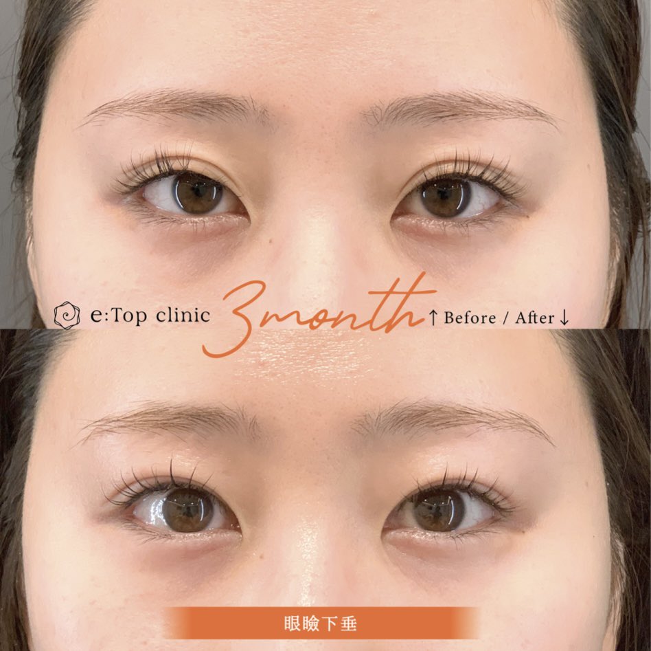 etopclinic's tweet photo. ⠀. ✎適応はどっち？

まぶたの重さやたるみに悩んでいる方🙌

「眉下リフト」と「眼瞼下垂」
どちらの手術が適しているのか迷う方が多くいます。

目的や方法、得られる効果には違いがあります👩🏻‍⚕️✨

🌱眉下リフトは、まぶたの皮膚が覆いかぶさることで生じる皮膚のたるみ切除

🌱眼瞼下垂は目を開く筋肉を調整し、目の開きを改善する手術

イメージとしては、
眉下リフト→「車のボディの修理🚗」
眼瞼下垂→「車のエンジンの修理💨」
にあたります。