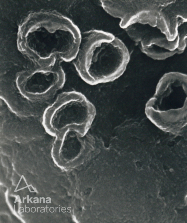 arkanalabs's tweet photo. Here is today’s #eyeSCANdy! Acellular scanning EM showing "craters" at high power on the subepithelial aspect of the glomerular basement membranes from a biopsy with membranous glomerulonephritis
Photo courtesy of Dr. Stephen Bonsib. #renal #pathology #kidneypath https://t.co/RtIlNwjfKb