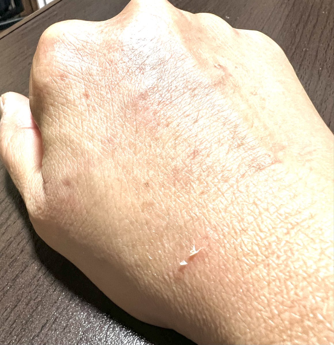 kuronron's tweet photo. 人間は毎日色々あって
嬉しかったり辛かったり
浮沈みの振り幅が大きい

犬は毎日同じ事の繰り返し
リピートしてるのか？と思う程

私の右手は
毎日毎日
歯型がついて皮が捲れる

たまに痛いけど嫌では無い https://t.co/JXrHKphiUa