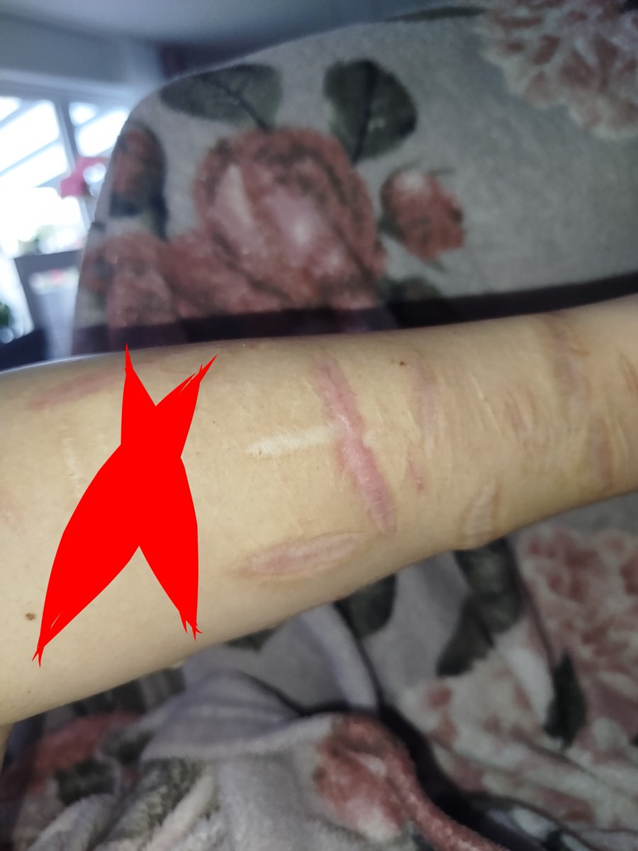 0calsp3rm's tweet photo. I might. Try something. Cuz all my scars are fading and I feel invalid https://t.co/zQma2O18dt