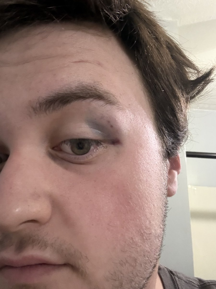 tobykolemma's tweet photo. Where I got kneed yesterday accidentally in jiu jitsu #brazilian jiu jitsu  #ufc #mma #fighting https://t.co/qPY0FmZJVA