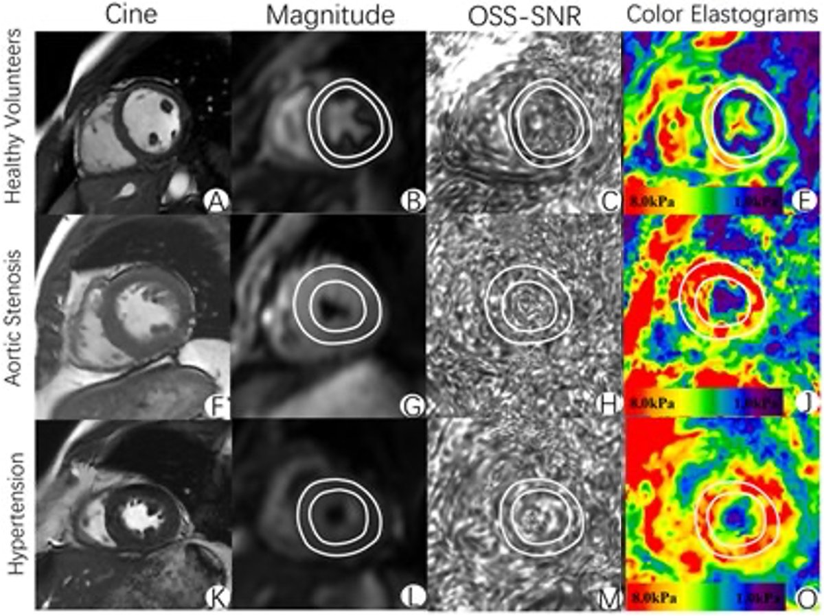 J__Huang's tweet photo. 3.0-T MR single frequency elastography of the heart demonstrated excellent long-interval reproducibility for quantifying myocardial stiffness, distinguishing true longitudinal changes from measurement variability.

@RSNA @OxfordJournals @SusannaLeeRad

https://t.co/MnMF7EzDIm https://t.co/7qPaPFlLQD