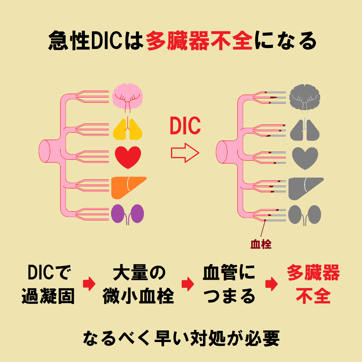 ce7meliteracy's tweet photo. 急性期の「播種性血管内凝固（DIC）」をまとめたよ！👏👏

DICとは「過凝固」のこと！？！？🤔💉

敗血症でよく起こるのね🤗✨🎉 https://t.co/yf5QWiASiK
