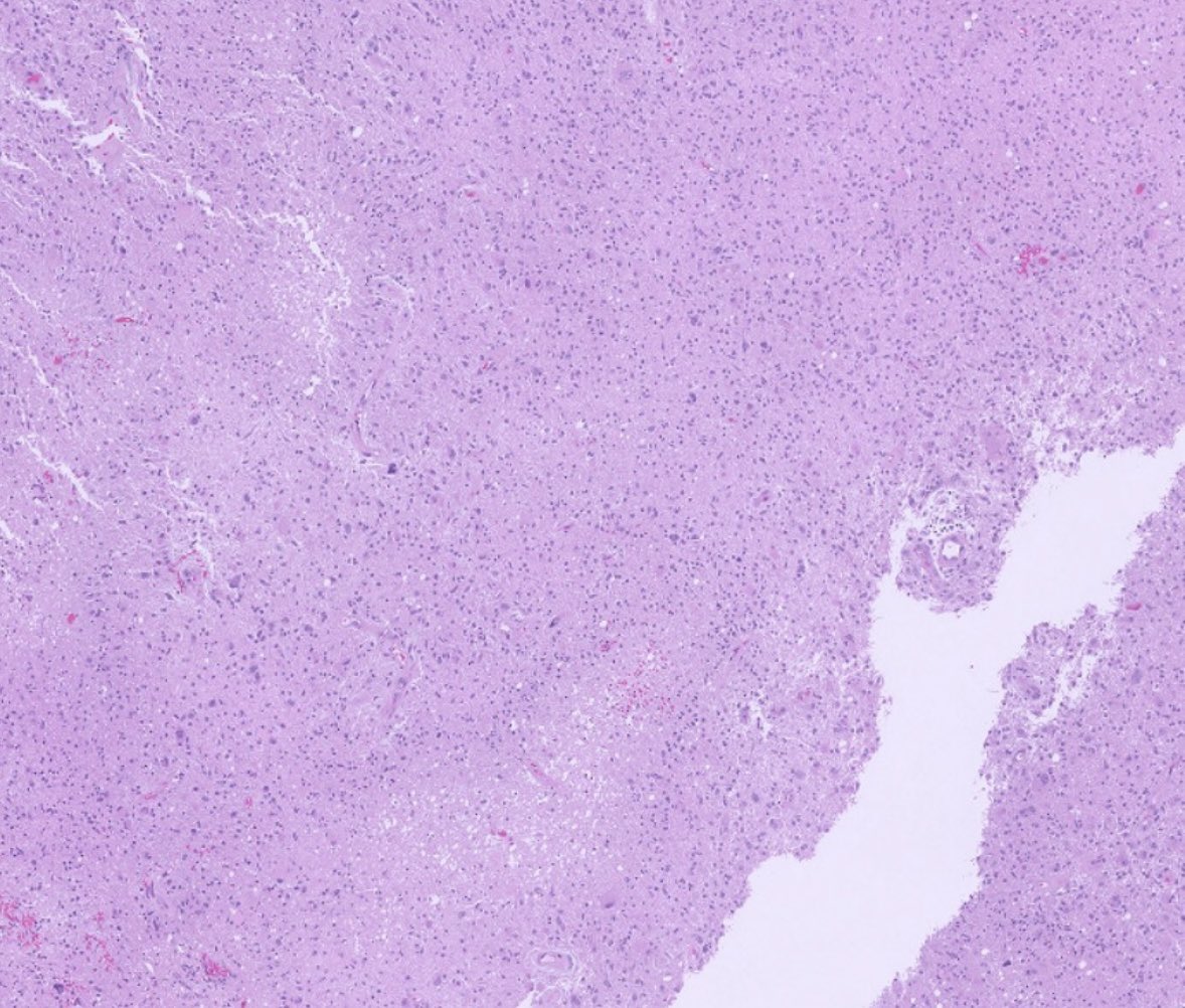 PeterKobalka's tweet photo. Re-resection, treated GBM. The initial “punched out” lesions from XRT may initially mimic necrosis with pseudo pallisading. However…
#Neuropathology #Neuropath #CNSpathology #Pathtwitter #Pathx https://t.co/DFCx55XL2Z