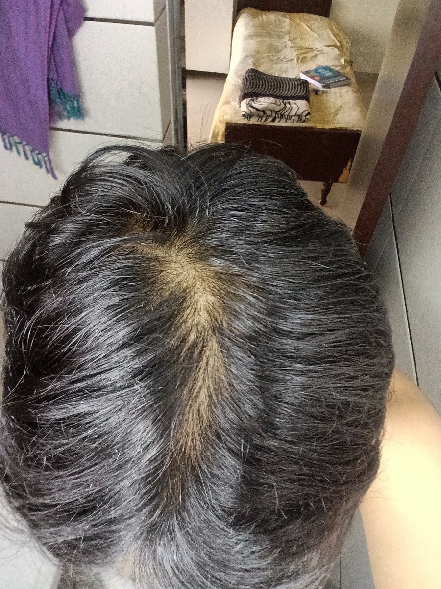 vartamanix's tweet photo. Is this hairline cooked m17 https://t.co/IdHzbkTARw
