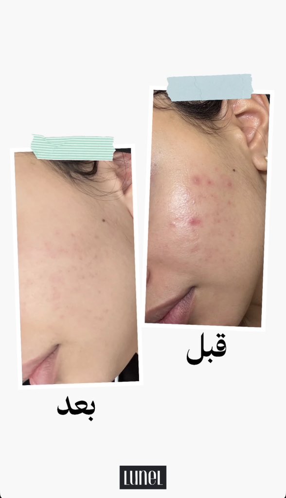 N3K_AB's tweet photo. شوفوا مجموعة النظارة من لونيل وش سوت فرق بالبشرة 😭🤎
الفرق بين قبل وبعد يتكلم عن نفسه ✨
كود الخصم: A99 🛍️ https://t.co/dNrCPjX1oP