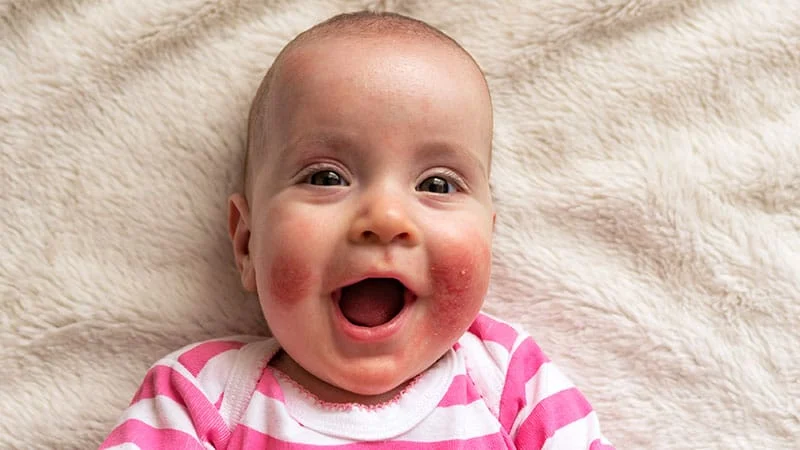 Aller_MD's tweet photo. #Pediatric #Atopic #Dermatitis: #Biologic Revolution Continues as Therapeutic Targets Expand. https://t.co/0Ll37GJ7KW https://t.co/q0hoybtSqE