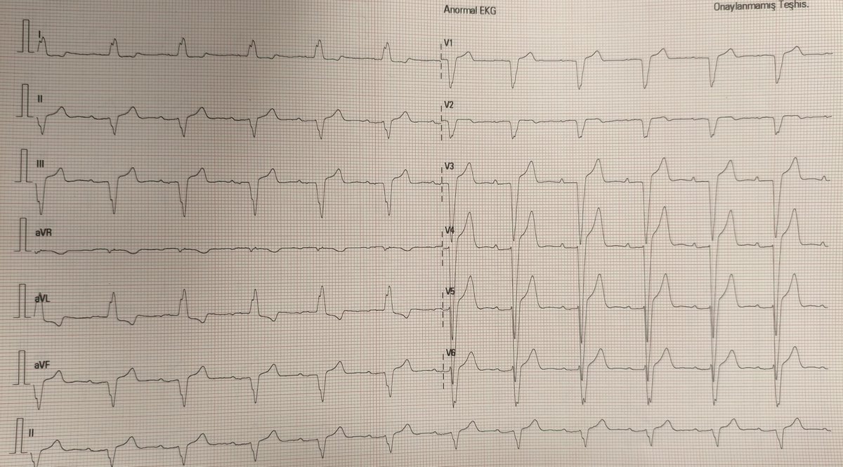 doktor__32's tweet photo. An 88-year-old female patient with no known medical history presented with nausea and vomiting. What do you see on the ECG?

@Ecgloverr @ecgrhythms @EcgsOnly https://t.co/BTsd4XydC4