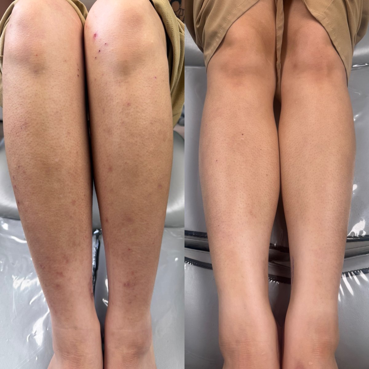 TT_LaserGrl's tweet photo. Skin Rejuvenation ONE Treatment #makewisechoices #wisechoice #Denver #colorado #PicoSure #Picosurelaser #picosureskinrejuvenation #laser #pigment #pigmentremoval #legs #anybodypark #fyp https://t.co/TdVdVd7OTI