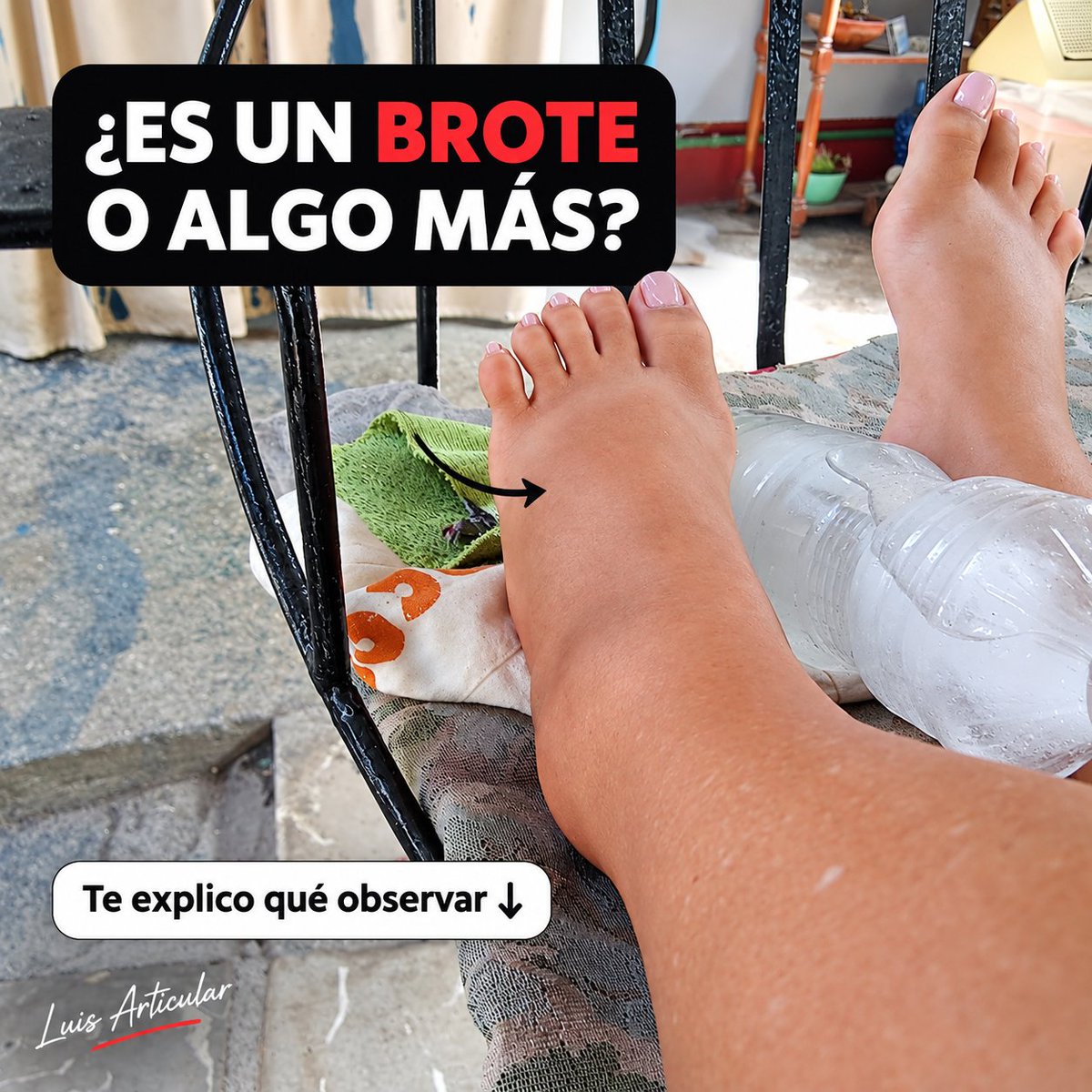 luisarticular's tweet photo. 🧐 La pregunta no es solo “¿está hinchado?”
ㅤ
Cuando un pie o tobillo aumenta considerablemente de volumen, es fácil atribuirlo a la artritis, especialmente si ya existe un diagnóstico de enfermedad articular. Pero la hinchazón es un signo que puede aparecer por mecanismos muy diferentes.
ㅤ
La clave está en aprender a reconocer el patrón.
ㅤ
Empecemos diferenciando inflamación articular y edema.
ㅤ
Una articulación inflamada puede presentar dolor, calor, sensibilidad, rigidez y limitación del movimiento. En enfermedades inflamatorias, como la artritis reumatoide, estos síntomas pueden intensificarse durante períodos de mayor actividad.
ㅤ
El edema es diferente: existe acumulación de líquido en los tejidos. Puede afectar el pie, rodear el tobillo y extenderse hacia la pierna. Algunas personas lo descubren porque los zapatos dejan de entrar o los calcetines marcan profundamente la piel.
ㅤ
Una observación sencilla es comprobar si al presionar suavemente una zona hinchada durante algunos segundos queda temporalmente una hendidura. Esto se denomina edema con fóvea. No indica por sí mismo qué enfermedad existe, pero aporta información sobre el tipo de hinchazón.
ㅤ
Después viene una pregunta fundamental: ¿es unilateral o bilateral?
ㅤ
Dos tobillos que se hinchan progresivamente durante el día pueden relacionarse con la acumulación de líquido favorecida por la gravedad y con dificultades en el retorno venoso.
ㅤ
Por ejemplo, alguien puede levantarse con los tobillos prácticamente normales, pasar ocho horas sentada trabajando y descubrir por la tarde que los zapatos aprietan.
ㅤ
La pantorrilla tiene un papel importante en el movimiento de la sangre desde las piernas. Por eso permanecer completamente inmóvil durante muchas horas puede favorecer la acumulación de líquido en algunas personas.
ㅤ
Levantarse periódicamente, caminar un poco y realizar movimientos suaves de flexión y extensión de tobillo puede ayudar cuando la causa está relacionada con inmovilidad y no existe una contraindicación.
ㅤ
La alimentación también puede influir. Un consumo elevado de sodio favorece retención de líquido en personas susceptibles. Y el sodio puede esconderse en alimentos que no siempre percibimos como extremadamente salados: panes industriales, embutidos, salsas, comidas preparadas, snacks y sopas instantáneas.
ㅤ
Pero cuidado con simplificarlo todo diciendo “es por la sal”.
ㅤ
Una hinchazón bilateral persistente también puede relacionarse con insuficiencia venosa y, en determinadas situaciones, con enfermedades cardíacas, renales, hepáticas u otros problemas médicos. Cuando el edema es nuevo, recurrente o progresivo, conocer su causa importa más que intentar ocultar el síntoma.
ㅤ
Ahora pensemos en un escenario diferente.
ㅤ
Te despiertas y una sola pierna está mucho más hinchada que la otra.
ㅤ
Puede existir una explicación musculoesquelética: un esguince, golpe, lesión, sobrecarga o inflamación localizada. Tal vez el día anterior pisaste mal bajando una escalera o caminaste durante horas con un calzado diferente.
ㅤ
Pero si una sola pierna se hincha repentinamente sin una explicación evidente y además aparece dolor, sensibilidad, calor o molestias en la pantorrilla, necesita valoración médica. Una de las causas importantes que debe descartarse es la trombosis venosa profunda.
ㅤ
Y existe una combinación de síntomas que cambia completamente la urgencia: hinchazón de una pierna acompañada de falta de aire repentina, dolor en el pecho, desmayo o dificultad para respirar. Ante ese escenario se requiere atención urgente.
ㅤ
La piel también aporta pistas.
ㅤ
Una zona progresivamente roja, caliente, dolorosa y acompañada de fiebre puede corresponder a una infección. No debería manejarse simplemente como si fuera retención de líquidos.
ㅤ
¿Y un brote de artritis?
ㅤ
También puede producir hinchazón. La diferencia es que suele acompañarse del resto del patrón inflamatorio: dolor articular, calor, rigidez, sensibilidad y menor movilidad. Dependiendo de la enfermedad, pueden verse afectadas varias articulaciones.
ㅤ
El error está en asumir que tener artritis convierte automáticamente cualquier edema en un brote.
ㅤ
Una persona puede tener artritis y, al mismo tiempo, desarrollar insuficiencia venosa, sufrir un esguince o presentar otra condición completamente independiente.
ㅤ
Por eso, cuando aparezca una hinchazón diferente a la habitual, reconstruye la historia.
ㅤ
¿Cuándo comenzó?
ㅤ
¿Fue cuestión de horas o de varios días?
ㅤ
¿Un lado o ambos?
ㅤ
¿Duele al caminar?
ㅤ
¿Está caliente?
ㅤ
¿Hay enrojecimiento?
ㅤ
¿La hinchazón está alrededor de una articulación o ocupa todo el pie?
ㅤ
¿El calcetín deja una marca?
ㅤ
¿Mejora después de dormir?
ㅤ
¿Aumenta después de estar mucho tiempo de pie?
ㅤ
¿Hubo un golpe o una torcedura?
ㅤ
¿Existe fiebre?
ㅤ
¿Hay dificultad para respirar?
ㅤ
Estas preguntas transforman “tengo el pie hinchado” en una descripción mucho más útil.
ㅤ
Incluso puedes registrar la evolución. Compara ambos pies por la mañana y al terminar el día. Observa el contorno del tobillo y del empeine. Si necesitas seguimiento, una fotografía tomada aproximadamente desde el mismo ángulo y a la misma hora puede ayudarte a identificar cambios.
ㅤ
En casos leves, conocidos y sin señales de alarma, el movimiento frecuente puede ser una herramienta sencilla. Si trabajas sentada, evita pasar toda la mañana sin levantarte. Camina periódicamente por la casa o la oficina y mueve suavemente los tobillos.
ㅤ
También puede resultar cómodo descansar con las piernas elevadas en determinados tipos de edema dependiente de la gravedad.
ㅤ
Si existe una lesión reciente, el frío protegido con una tela puede ayudar a controlar temporalmente dolor e inflamación localizada. No debe aplicarse hielo directamente sobre la piel.
ㅤ
Y hay cosas que no conviene hacer a ciegas.
ㅤ
No masajees con fuerza una pierna que se hinchó repentinamente sin conocer la causa. No intentes solucionar cualquier edema recurriendo por tu cuenta a productos diuréticos. Y no reduzcas drásticamente el agua pensando que “si no bebo, no retengo”.
ㅤ
La estrategia adecuada depende de la causa.
ㅤ
También es razonable consultar cuando la hinchazón se repite constantemente, aumenta progresivamente, empieza a interferir con caminar, aparece sin explicación, afecta únicamente una extremidad o se acompaña de otros síntomas.
ㅤ
A veces el primer cambio cotidiano es pequeño: una sandalia que deja una marca nueva, un tobillo que pierde su contorno o una dificultad inesperada para ponerse el calzado.
ㅤ
Eso no significa automáticamente que exista una enfermedad grave. Significa que tu cuerpo está mostrando un cambio que merece contexto.
ㅤ
La misma apariencia puede esconder mecanismos diferentes.
ㅤ
Inflamación articular.
ㅤ
Lesión.
ㅤ
Edema por inmovilidad.
ㅤ
Alteraciones venosas.
ㅤ
Infección.
ㅤ
Problemas vasculares.
ㅤ
O determinadas condiciones sistémicas.
ㅤ
Por eso, si tienes artritis y notas tus pies hinchados, no necesitas entrar inmediatamente en alarma, pero tampoco conviene asumir que “es mi artritis y ya”.
ㅤ
Observa el patrón, identifica qué ha cambiado y presta especial atención a los síntomas que acompañan la hinchazón.
ㅤ
Comprender el origen es el primer paso para saber qué cuidado tiene sentido.
ㅤ
Si quieres profundizar en cómo reconocer cambios articulares y cuidar mejor tu movilidad, visita el enlace de mi perfil.
ㅤ
#edema