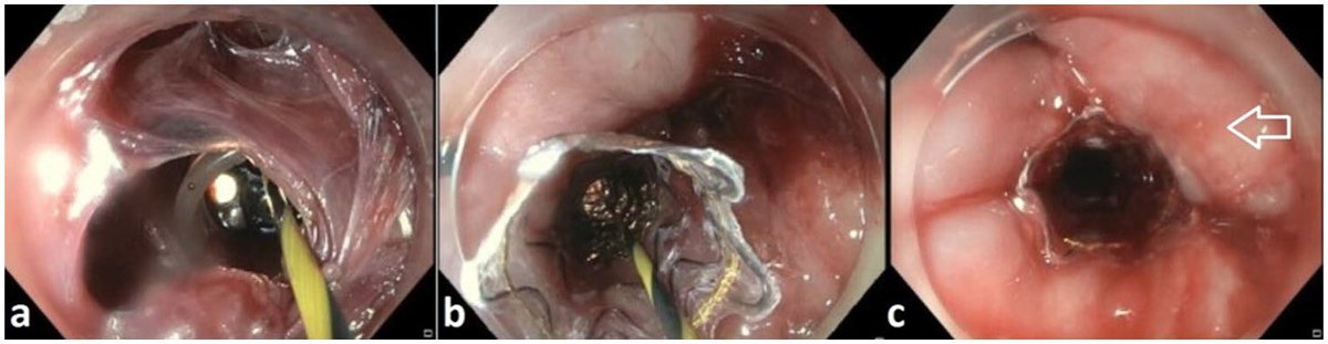 foregut_journal's tweet photo. 🆕 Now in @foregut_journal 

🔄 Endoscopic Rendezvous for Complete Esophageal Obstruction

🔹 Restoring esophageal continuity
🔹 Key technical considerations
🔹 Outcomes &amp; complications

🔗 Read more: https://t.co/0s9kq3oLLK

#Foregut #Endoscopy #Esophagus https://t.co/UsgYH9JAzb