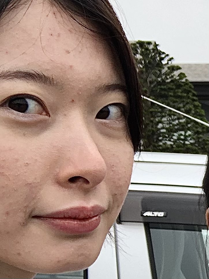 Cinder_nurse's tweet photo. 👈小麦抜いて甘いもの我慢して野菜とってしっかりすすいで8時間以上寝て枕カバー毎日替えて制限制限制限の生活
(これがだらしない生活ってマジ⁉️😅)

👉ラーメンもパンも食べるし新作フラペチーノ必ず飲む我慢しない生活

肌荒れの原因になるようなことぜーんぶ気をつけて生活してたのがだらしない生活だったってコト⁉️😅キレそう

持論としては何食食べてもできる時はできるし、制限してストレスになるくらいなら食べてもいいと思う(もちろん食べ過ぎは良くないけど)

私の場合は自分に合ったスキンケアが1番でした🫶🏻

beforeの写真使い回しでごめんなさい😭
コンプレックスだったから写真が少ないんです😭
