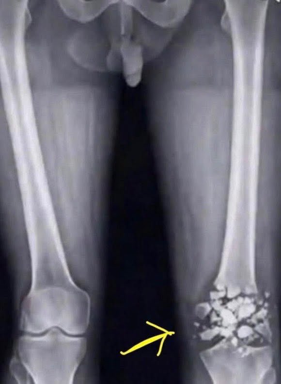 manhwal0vr's tweet photo. my knee is completely shattered… long recovery ahead for me https://t.co/lmvczQ8aoC