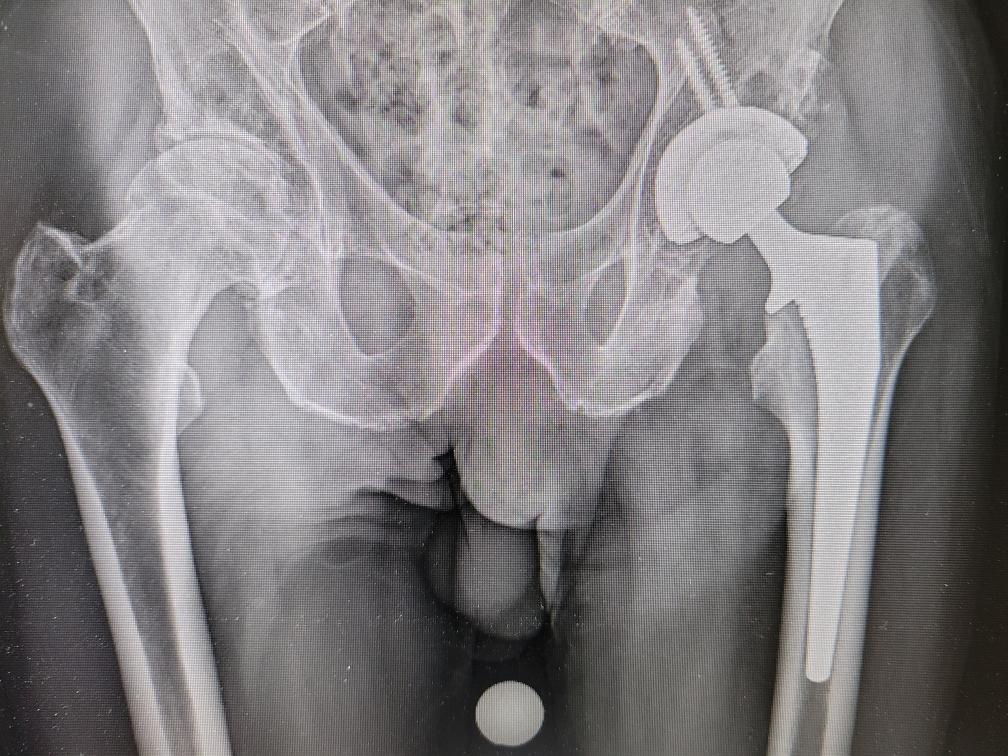 lurehound777's tweet photo. @BearFanPete_FF That's what I said .... Left hip replacement ... https://t.co/Fgo2Pvtell