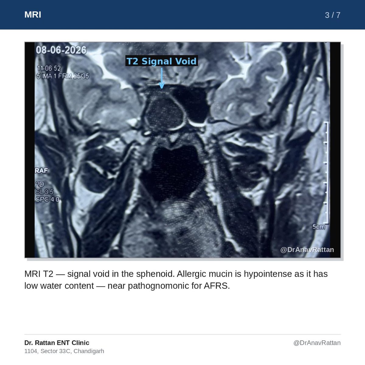 rattananav's tweet photo. He came in with just a headache. The scan told us why.

CT: double density sign. MRI: T2 signal void. Classic for AFRS — allergic fungal rhinosinusitis, isolated to the sphenoid.

Cleared endoscopically via medial corridor.

#ENT #AFRS #FESS #MedTwitter https://t.co/I2L9aQ9CuK