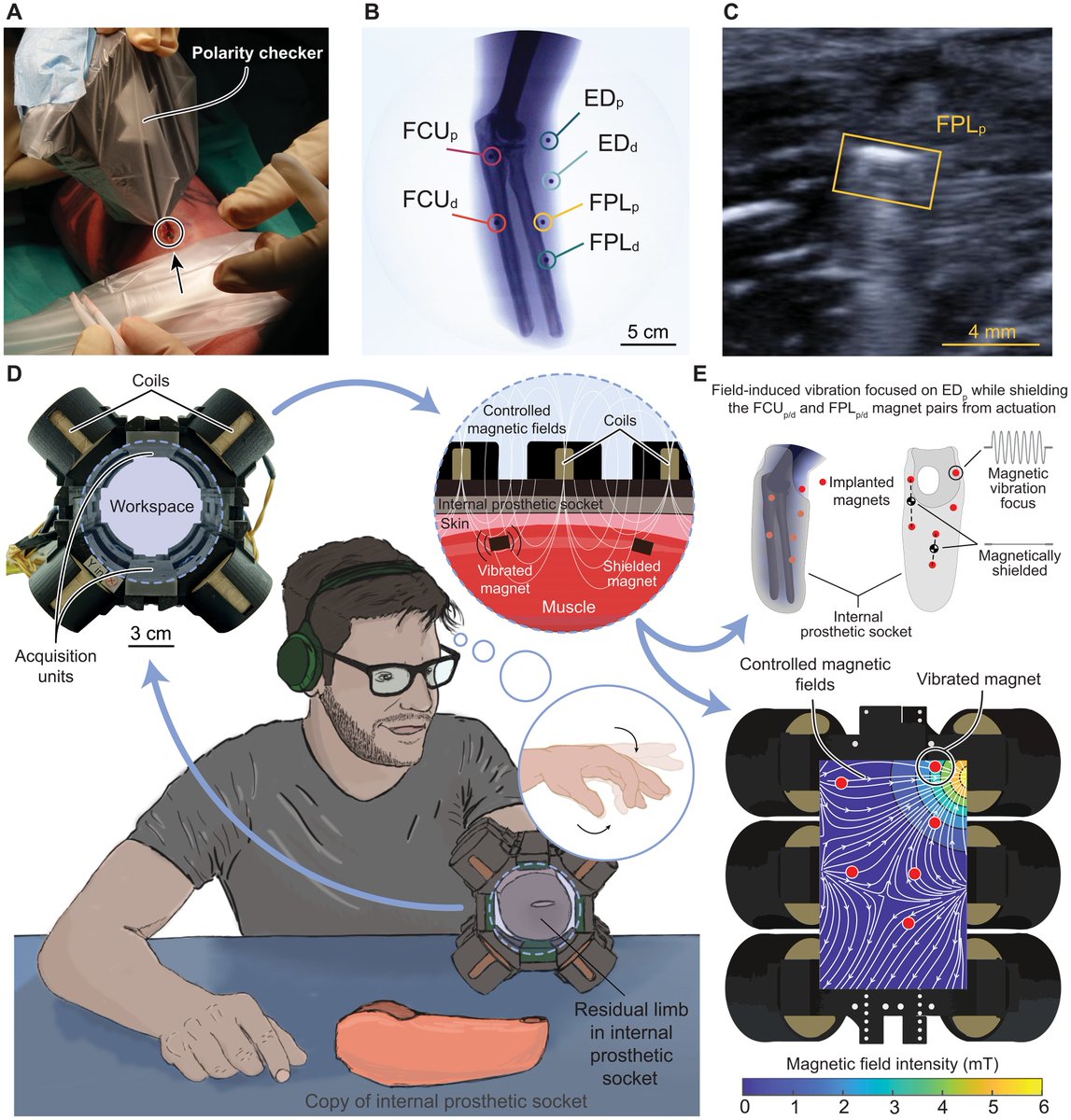 NatMed_Research's tweet photo. A magnetic prosthetic interface was designed to provide sensory feedback alongside control.

WOW!

We may be getting closer to prostheses that don’t just move like a body part.

🔗https://t.co/nQbi34C16k

#prosthetics https://t.co/T61V8R6A6U