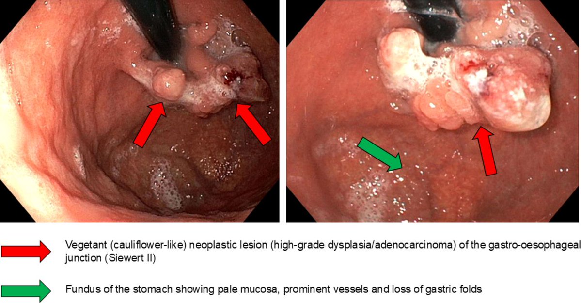 Gut_BMJ's tweet photo. Autoimmune gastritis has traditionally been viewed mainly as a risk factor for gastric neuroendocrine tumours and non-cardia gastric adenocarcinoma. But could its cancer risk extend further?

Read the #RecentAdvancesInClinicalPractice #GUTRecentAdvancesInClinicalPractice by Lenti et al. entitled “Autoimmune gastritis: a hidden gateway to cardia and oesophageal cancers beyond non-cardia gastric adenocarcinoma” via  https://t.co/Ve38KXIdju

This review brings together emerging epidemiological and clinical evidence suggesting that autoimmune gastritis and pernicious anaemia may also be associated with malignancies involving the gastric cardia, gastro-oesophageal junction and oesophagus.

The authors explore possible mechanisms including corpus-predominant atrophy, intestinal metaplasia and vitamin B12 deficiency, while highlighting important gaps in our current understanding.

The review challenges us to think beyond the traditional boundaries of autoimmune gastritis and raises important questions about future risk stratification and surveillance.

#AutoimmuneGastritis