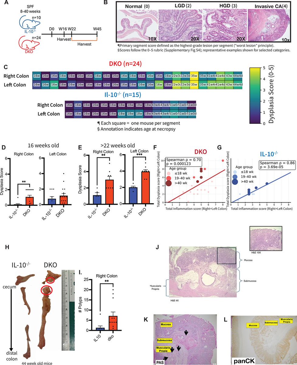 Gut_BMJ's tweet photo. The study is this month’s #GUTEditorsChoice and features on the #GUTFrontCover.
Awoniyi et al. present “Dysbiotic microbiota trigger colitis-associated colorectal cancer and imprint a distinctive bile acid profile in a PSC-IBD model” via https://t.co/323tdbgg3y
PSC-associated IBD carries a particularly high risk of colorectal neoplasia. This study provides important mechanistic insight into how the gut microbiome may contribute to that risk.
The authors demonstrate that dysbiotic microbiota can promote colitis-associated colorectal cancer while producing a distinctive bile-acid signature. These findings strengthen the emerging view that microbial communities and their metabolites can actively shape the intestinal environment in ways that influence carcinogenesis.
🎙️ It is also the subject of the September #GUTPodcast.
▶️ Listen on Apple Podcasts:
https://t.co/0b82LZtDsa
▶️ Listen on Spotify:
https://t.co/KtzwyJzbiv
▶️ Listen on the Gut Podcast website:
https://t.co/rPgRsmc9Dg
#GUTFrontCover #GUTCover #GUTPodcast
