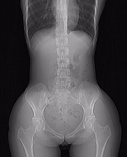 RaphaelMemes's tweet photo. Paciente feminina de 25 anos veio na UPA se queixando de fortes dores abnominais, foi encaminhada para raio X.

Você consegue dizer se há um problema com este escaneamento abdominal? https://t.co/gOy5PUAYhk