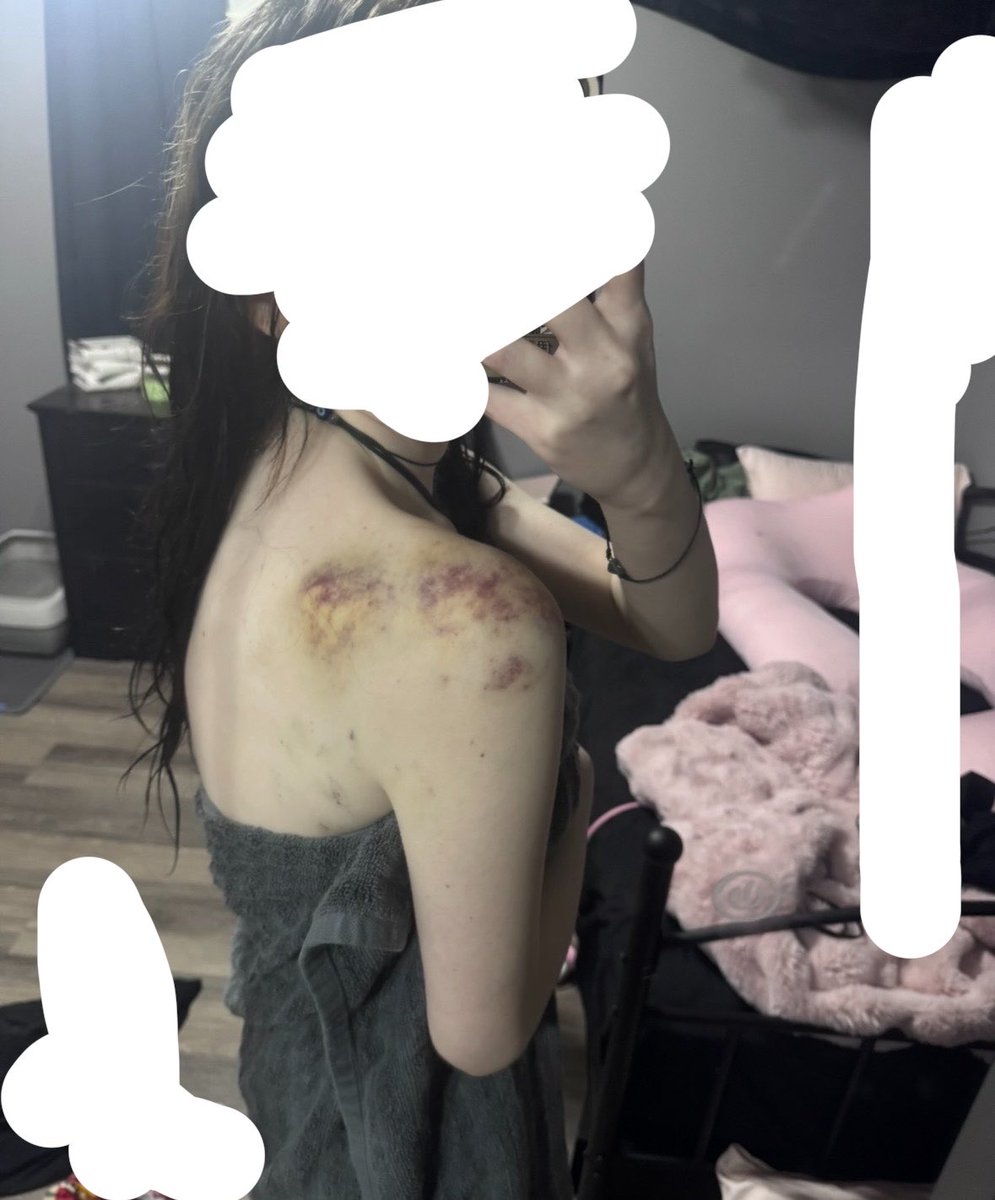 fawnalicous's tweet photo. i miss bruising https://t.co/DYGy6QDwTs