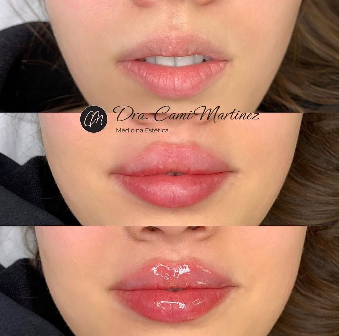 marthamor1hs's tweet photo. Los labios rusos 😍👄 le dan muchísima belleza y vida a tu rostro ☺️ ¡pide tu cita mediante dm o whats app! https://t.co/mYSbMmxMcT