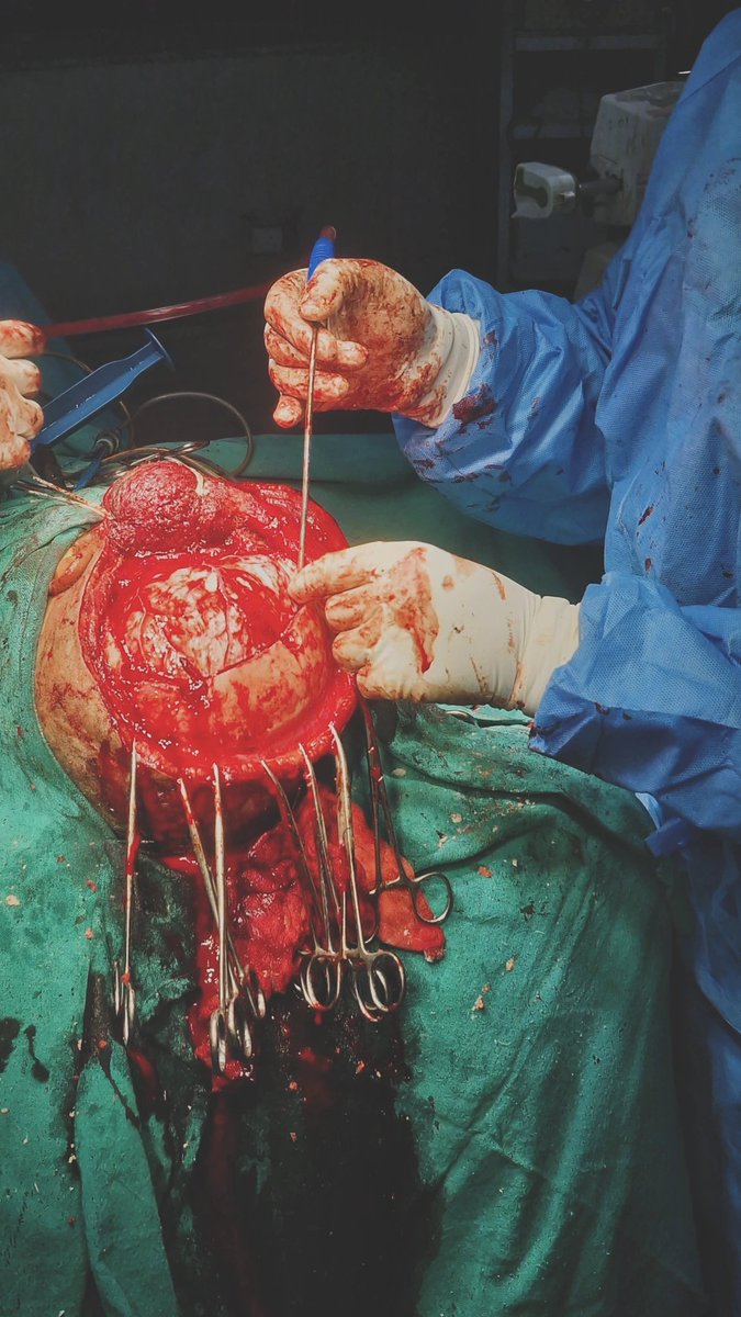 gypsymedico's tweet photo. Why decompressive craniectomy in a temporal contusion?

- Cerebral edema → ↑ ICP
-Temporal swelling → mass effect
 -Medial temporal displacement → risk of uncal herniation
-Decompression → ↓ ICP + ↑ intracranial compliance https://t.co/LIoVSi3HZu